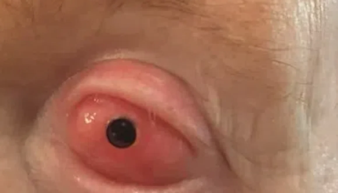 Tooth In Eye Surgery