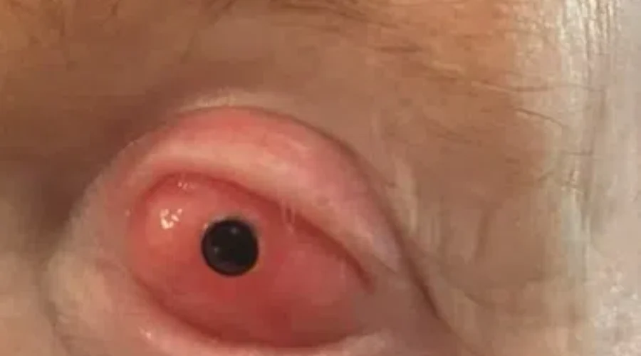 Canada’s First Tooth-In-Eye Surgery Could Restore Patients Vision